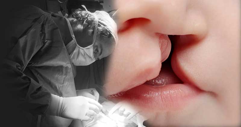 Dudak Damak Yarıkları