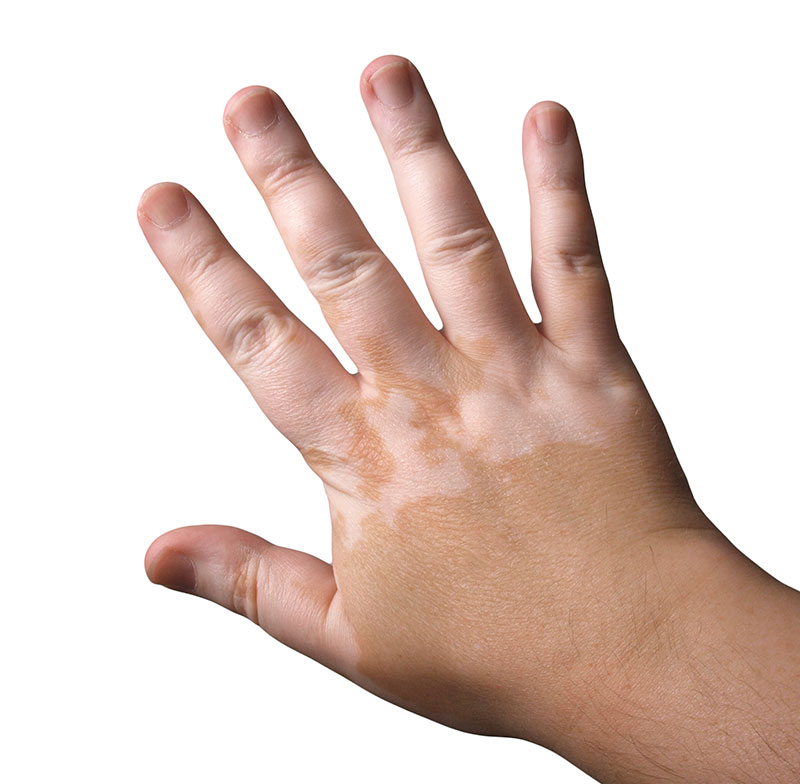 Vitiligo Tedavisi