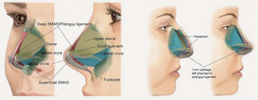 Preservation Rhinoplasty - Koruyucu Rinoplasti 1